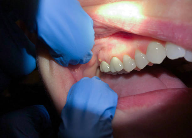 Best Emergency Dental Care for Broken or Chipped Teeth in Quail Creek, TX